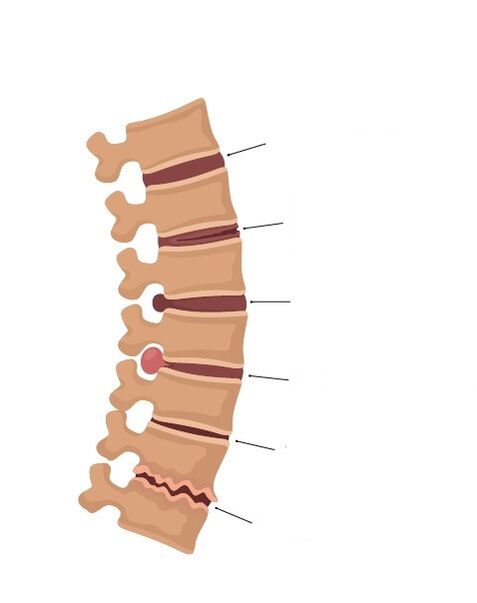 Bone changes in the spine