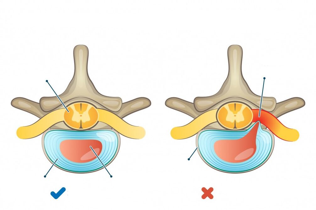 intervertebral disc - one healthy, the other with herniation