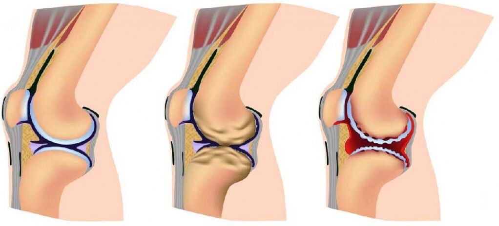 Joints healthy and affected by arthrosis