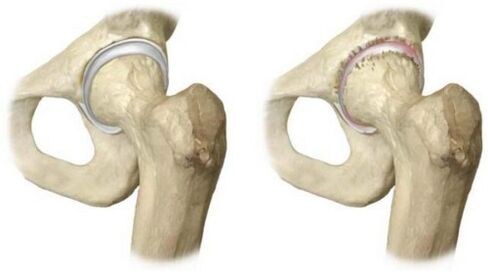 healthy hip joint and affected by arthrosis